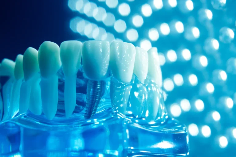 Protetyka na implantach Warszawa