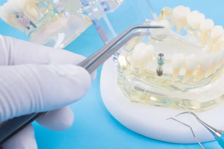 Implanty dentystyczne Warszawa