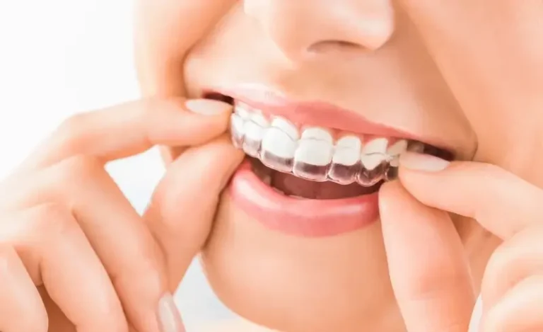 Noszenie nakładek Invisalign